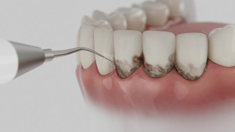 Trusted Tooth Extraction service in Cartersville, GA - Dentist Open Now